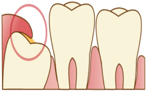 親知らずの周囲の歯茎の腫れ（智歯周囲炎）　歯の痛み
